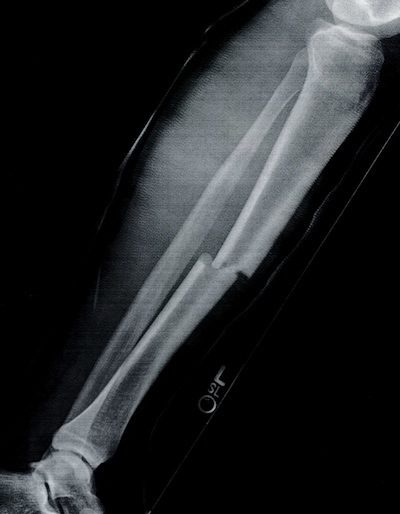 An x-ray of Hoglunds broken tibia.